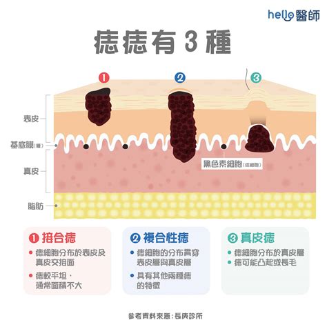 為什麼痣會長毛|痣形成的原因？痣長毛、痣變多變大是痣病變？5招判別